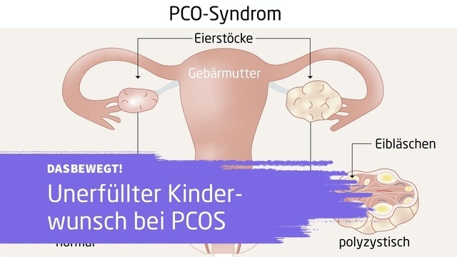 dasbewegt!: Wie lebt es sich eigentlich mit PCOS?