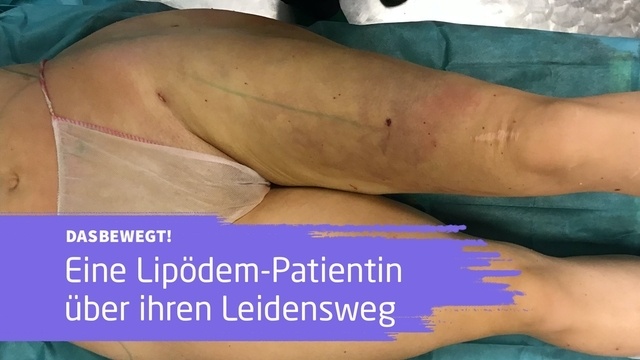 dasbewegt!: Wie lebt es sich eigentlich mit Lipödem?